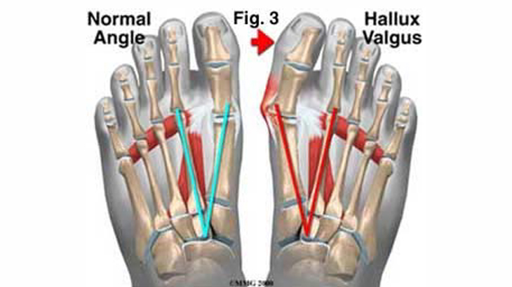 脚的图形显示一个正常的角度和一个拇指外翻拇囊炎切除术。之前