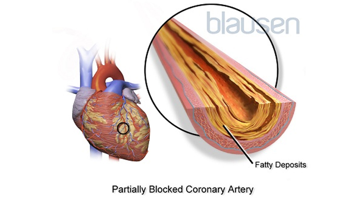 图示部分阻塞的冠状动脉内视图，有多层脂肪沉积，以及心脏上可以找到这条动脉的位置。