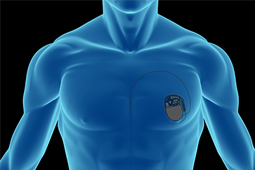 一具男性躯干的图片，心脏装有起搏器